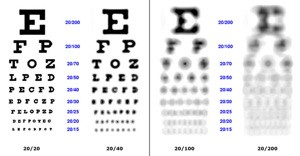 What Eye Prescription is Considered Bad? 4 image 23