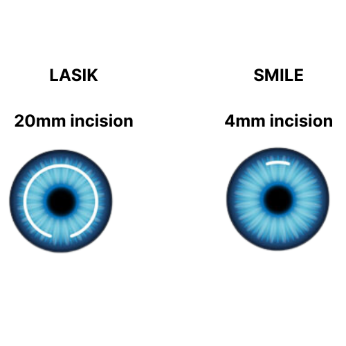 What Is the Difference Between SMILE and LASIK Eye Surgery? 4 LASIK vs SMILE procedure illustration