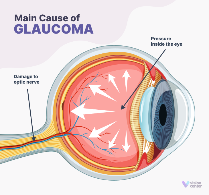 Glaucoma: Types, Symptoms, Causes, and Treatment 5 main cause of glaucoma