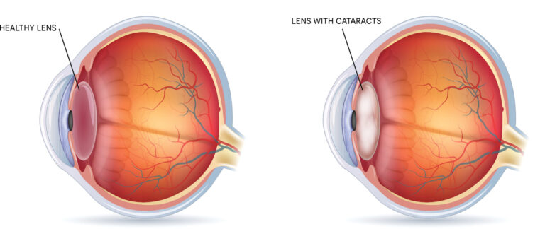 Glaucoma vs Cataracts 4 How cataracts develops - Healthy Eye vs Eye with Cataract