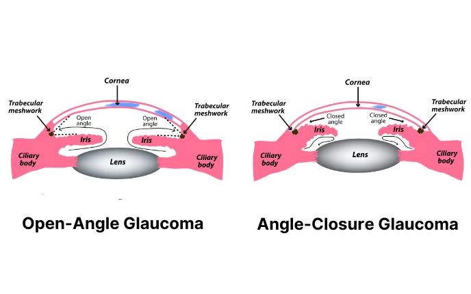 Glaucoma: Types, Symptoms, Causes, and Treatment 7 Open Angle and Angle Closure Glaucoma Illustration edited