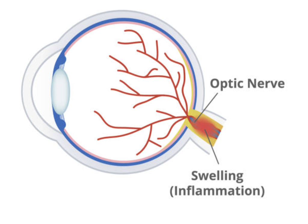 What Causes Eye Pain? Is It Dangerous? 15 Optic Neuritis illustration
