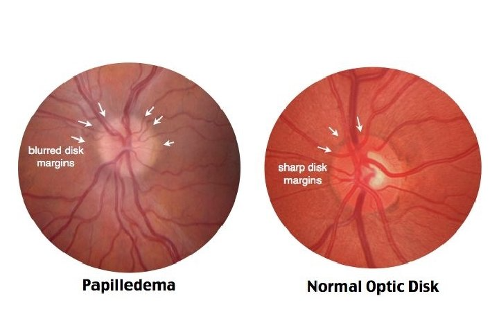 Papilledema (Swollen Optic Nerve) 4 Papilledema vs. Normal Optic Disk edited