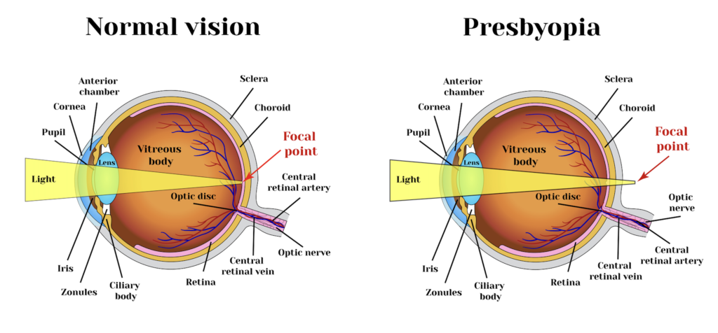 What to Know About Monovision LASIK 4 Presbyopia illustration