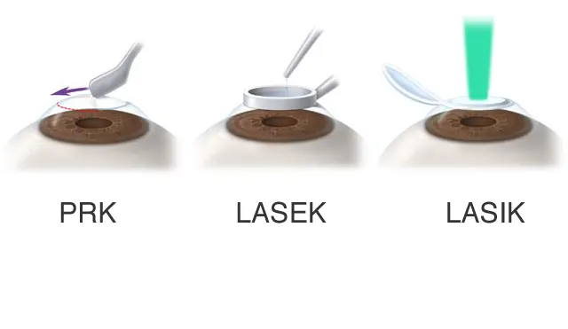 LASEK vs. LASIK: What’s the Difference? 6 PRK vs LASEK vs LASIK