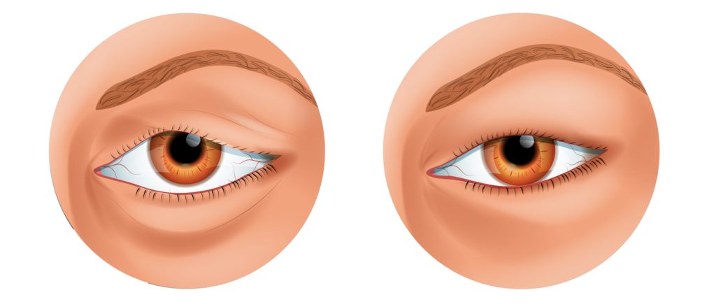What Causes Swollen Eyelids? 3 Swollen eyelid medical illustration